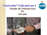 Colla-pad:Pressure sore for  one year