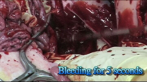 Hemo-Bandage: aorta hemostasis 